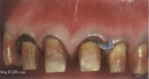 牙龈下外形的处理