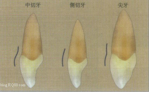 天然牙cej附近的突度在中切牙最强,尖牙次之,侧切牙基本为平坦状态